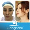 Hình ảnh khách hàng lột xác sau khi sửa mũi hỏng tại Gangnam Hình ảnh khách hàng lột xác sau khi sửa mũi hỏng tại Gangnam
