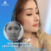 Hình ảnh khách hàng lột xác sau khi sửa mũi hỏng tại Gangnam Hình ảnh khách hàng lột xác sau khi sửa mũi hỏng tại Gangnam